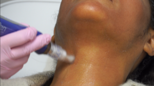 Benefits of Microneedling