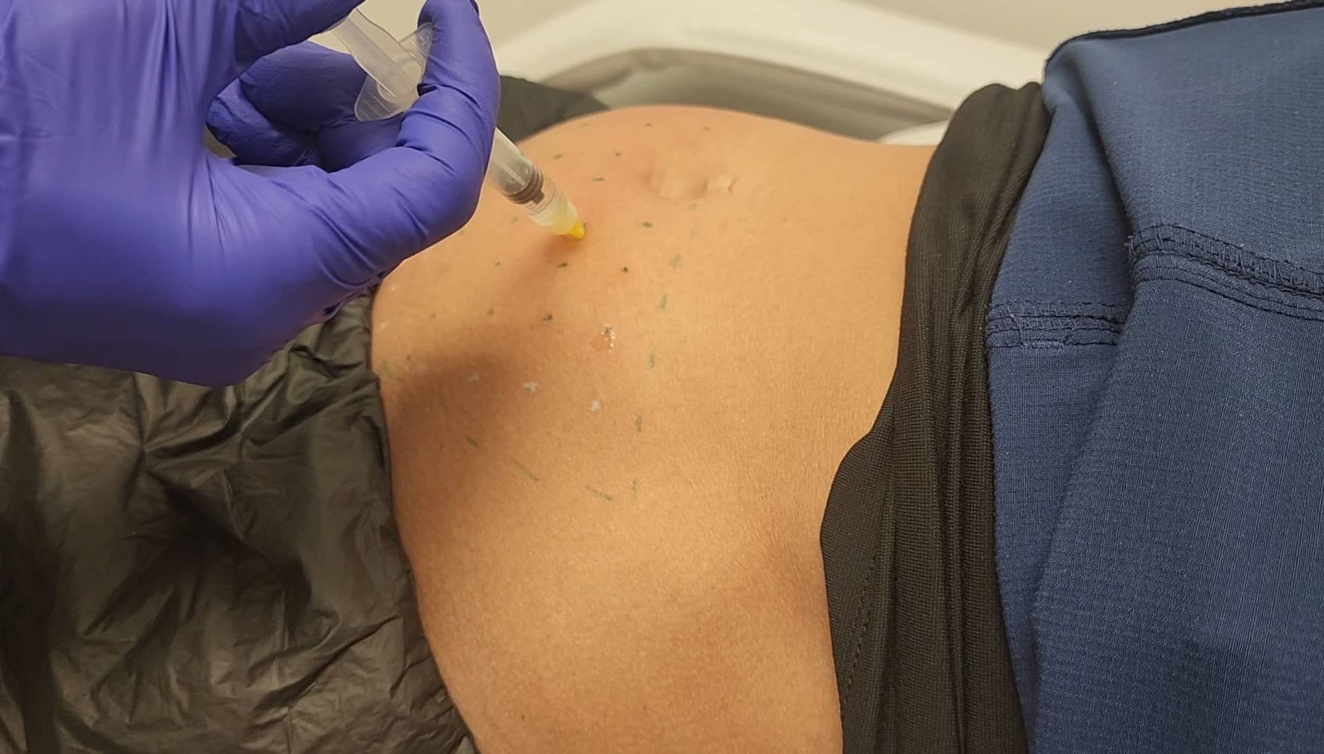 What Is Mesotherapy For Weight Loss