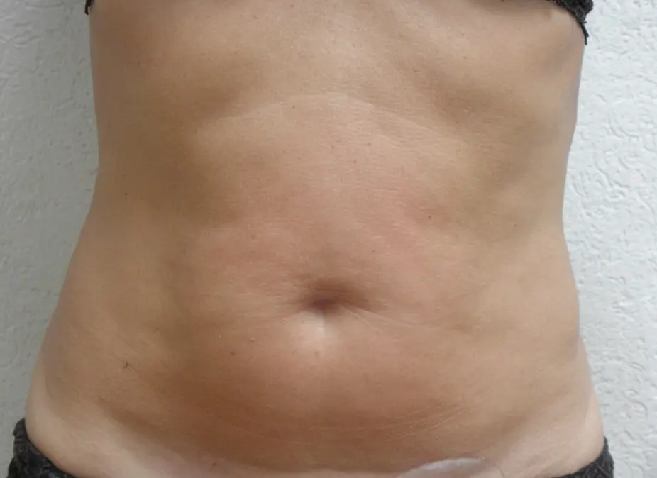 Non-Invasive Body Contouring